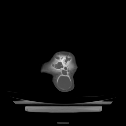 Cloverleaf skull (Radiopaedia 91901-109710 Axial bone window 140).jpg
