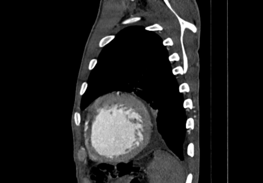 Coarctation of aorta with aortic valve stenosis (Radiopaedia 70463-80574 B 197).jpg