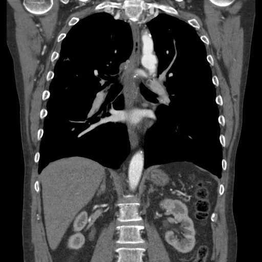 Coarctation of the aorta (Radiopaedia 17427-17116 A 39).jpg