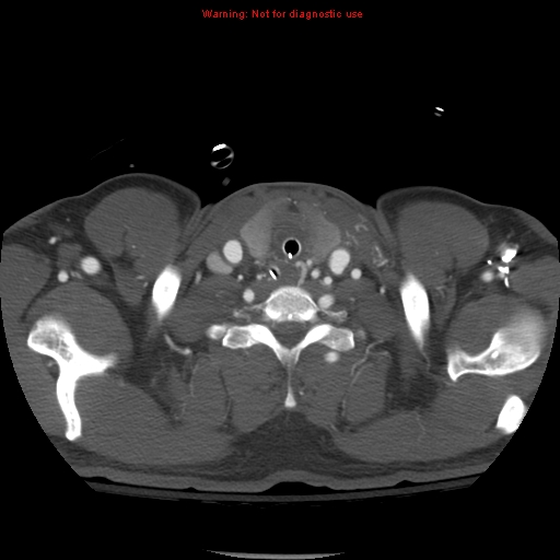 File:Coarctation of the aorta (Radiopaedia 8681-9490 B 6).jpg