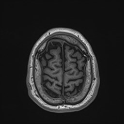 File:Cochlear incomplete partition type III associated with hypothalamic hamartoma (Radiopaedia 88756-105498 Axial T1 170).jpg