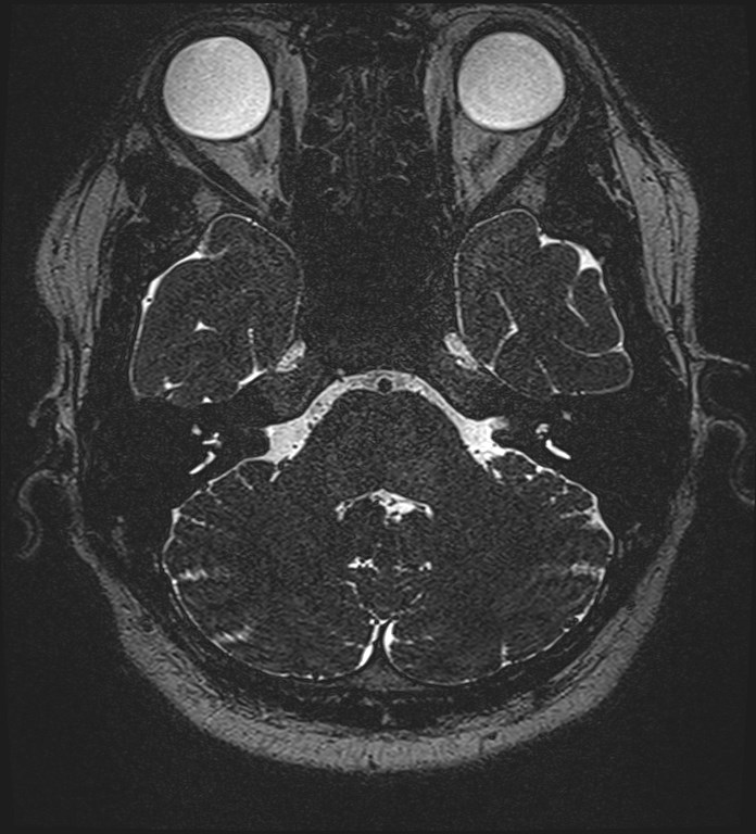 Cochlear incomplete partition type III associated with hypothalamic hamartoma (Radiopaedia 88756-105498 Axial T2 79).jpg