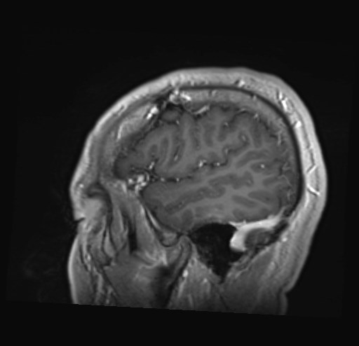 File:Cochlear incomplete partition type III associated with hypothalamic hamartoma (Radiopaedia 88756-105498 Sagittal T1 C+ 10).jpg