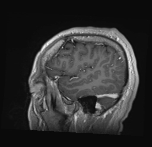Cochlear incomplete partition type III associated with hypothalamic hamartoma (Radiopaedia 88756-105498 Sagittal T1 C+ 44).jpg