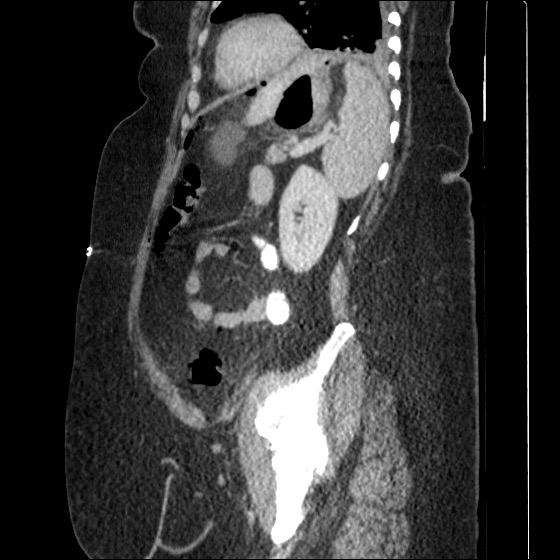 File:Collection due to leak after sleeve gastrectomy (Radiopaedia 55504-61972 C 25).jpg