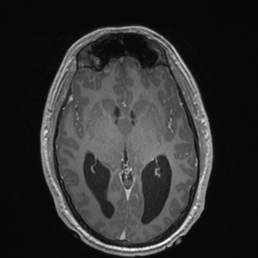 File:Colloid cyst (Radiopaedia 44510-48181 Axial T1 C+ 88).png