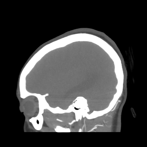 File:Colloid cyst (resulting in death) (Radiopaedia 33423-34499 B 44).png