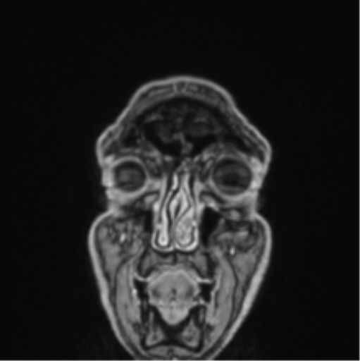 File:Colloid cyst of the third ventricle (Radiopaedia 86571-102662 Coronal T1 C+ 86).png