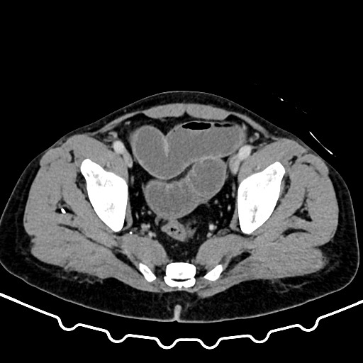 File:Colocolic intussusception due to large lipoma (Radiopaedia 68773-78482 A 168).jpg
