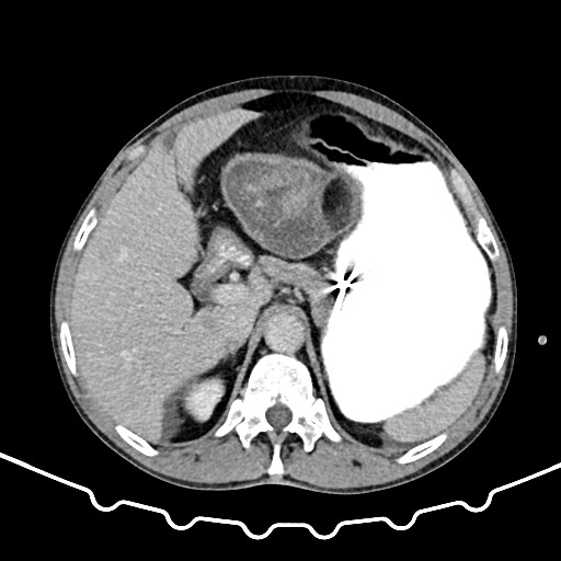 File:Colocolic intussusception due to large lipoma (Radiopaedia 68773-78482 A 40).jpg