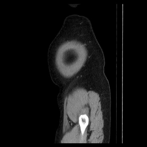 Colocolic intussusception due to tubular adenoma (Radiopaedia 73744-84551 C 145).jpg