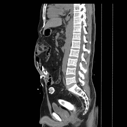 Colocutaneous fistula in Crohn's disease (Radiopaedia 29586-30093 F 18).jpg