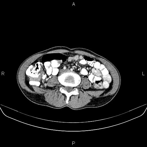 File:Colon adenocarcinoma - hepatic flexure (Radiopaedia 85635-101395 A 55).jpg