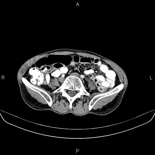 Colon adenocarcinoma - hepatic flexure (Radiopaedia 85635-101395 A 61).jpg