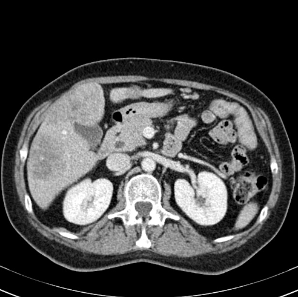 Colon carcinoma with hepatic metastases (Radiopaedia 29477-29961 A 41).jpg