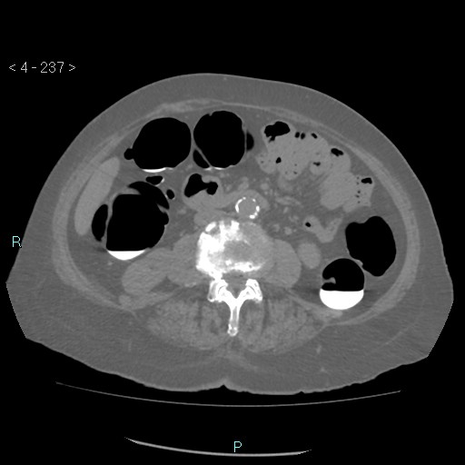 File:Colonic lipomas (Radiopaedia 49137-54244 Axial bone window 105).jpg