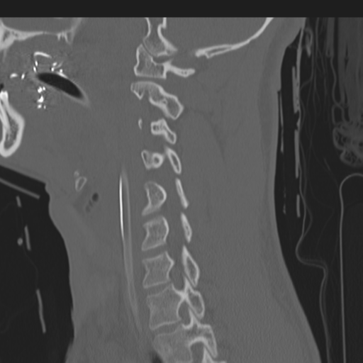 File:Multitrauma with diffuse axonal injury, temporal bone fractures and traumatic caroticocavernous fistula (Radiopaedia 37242-39035 Sagittal 18).png