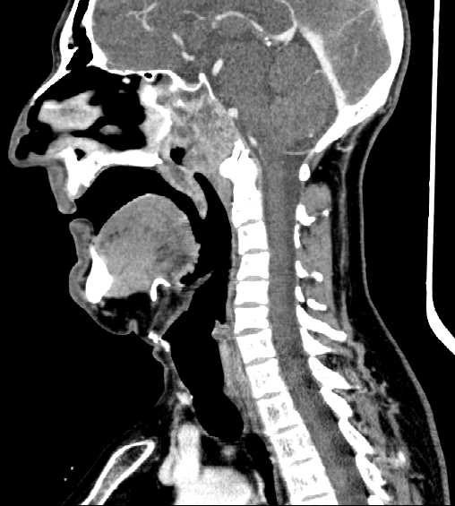 File:Nasopharyngeal carcinoma - infiltrating the clivus (Radiopaedia 62583-70875 C 27).jpg
