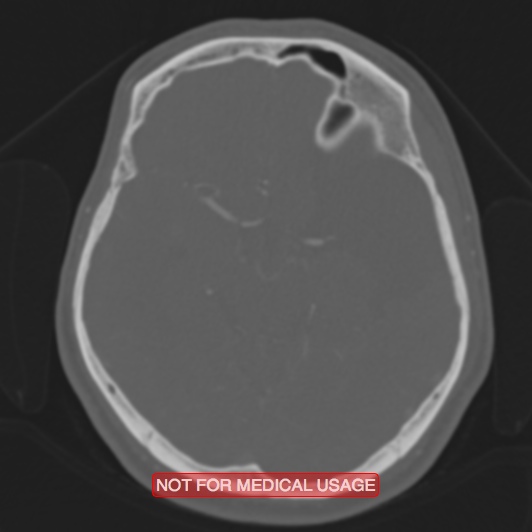 File:Nasopharyngeal carcinoma recurrence - skull base destruction (Radiopaedia 29107-29490 Axial bone window 61).jpg