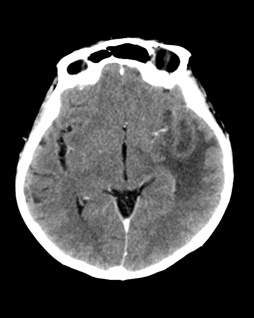 Nasopharyngeal carcinoma with cerebral abscess (Radiopaedia 43018-46275 Axial C+ delayed 24).png