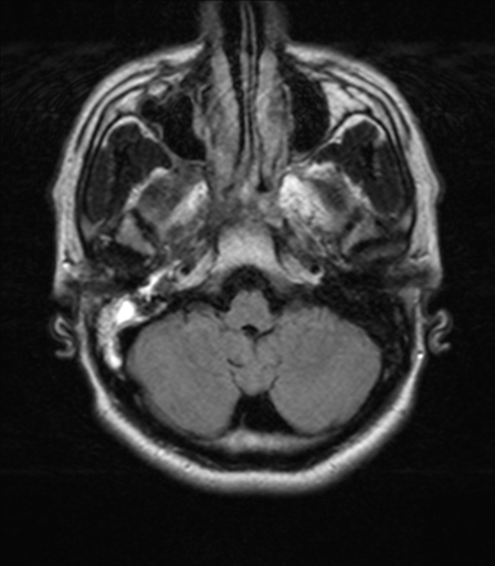 File:Nasopharyngeal carcinoma with pterygopalatine fossa involvement (Radiopaedia 33102-34134 Axial FLAIR 5).png