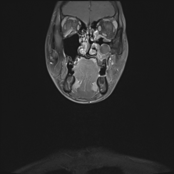 Nasopharyngeal carcinoma with skull base invasion (Radiopaedia 53415-59485 E 33).jpg