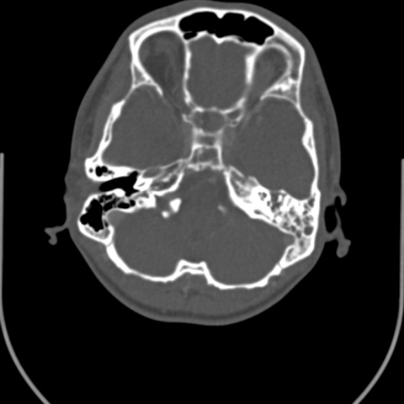 Nasopharyngeal carcinoma with skull base invasion (Radiopaedia 53415-59705 Axial bone window 11).jpg