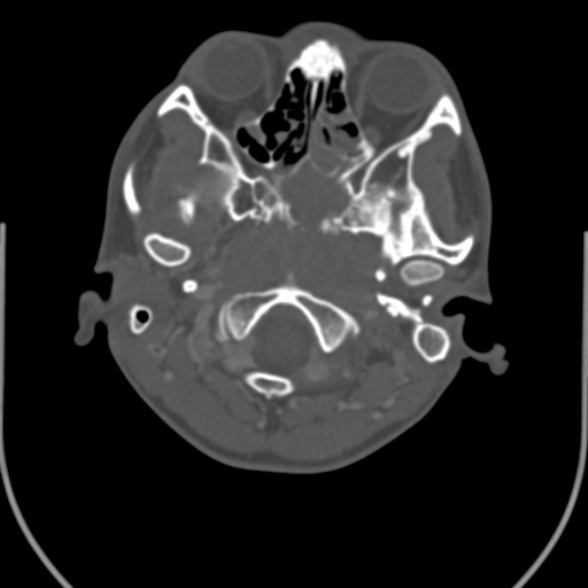 Nasopharyngeal carcinoma with skull base invasion (Radiopaedia 53415-59705 Axial bone window 30).jpg