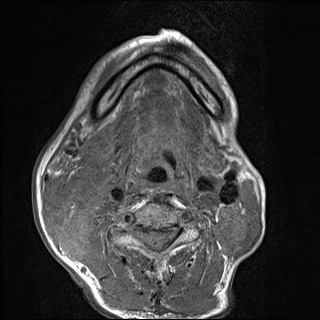 Nasopharyngeal carcinoma with skull base invasion (Radiopaedia 59258-66600 B 44).jpg