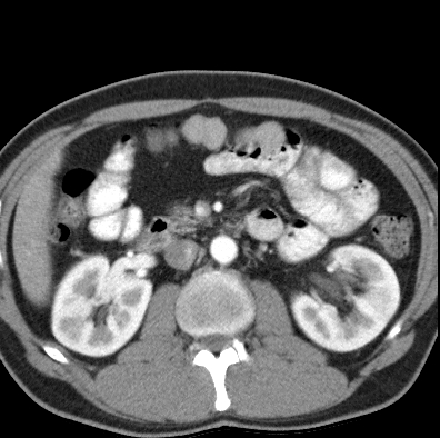 File:Necrotizing pancreatitis with acute necrotic collection (Radiopaedia 14470-14417 B 20).jpg