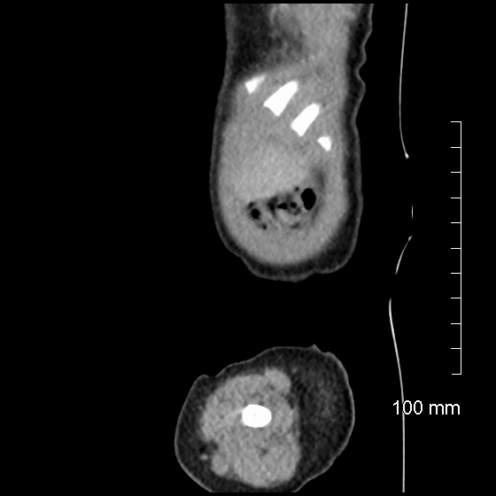 File:Neonatal neuroblastoma (Radiopaedia 56651-63438 C 14).jpg
