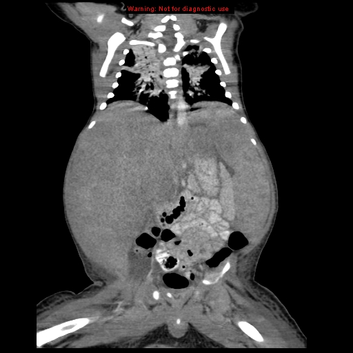 File:Neonatal neuroblastoma (Radiopaedia 9564-10223 B 78).jpg