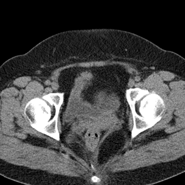 File:Nephrostomy for urosepsis (Radiopaedia 26180-26330 Axial non-contrast 64).jpg