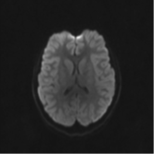 Neurenteric cyst (Radiopaedia 58641-65837 Axial DWI 56).png