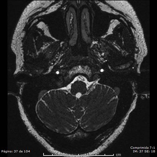 Neurocysticercosis (Radiopaedia 58636-65832 I 37).jpg