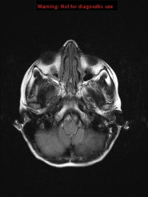 File:Neurofibromatosis type 1 with optic nerve glioma (Radiopaedia 16288-15965 Axial FLAIR 21).jpg