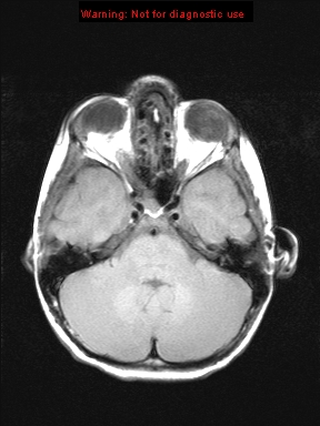 File:Neurofibromatosis type 1 with optic nerve glioma (Radiopaedia 16288-15965 Axial T1 18).jpg