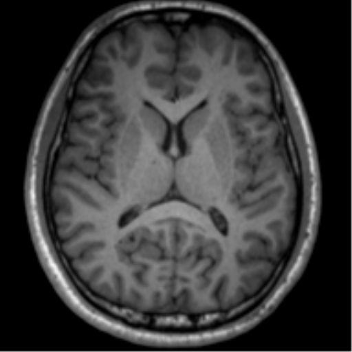 File:Neurofibromatosis type 2 (Radiopaedia 44936-48838 Axial T1 80).png