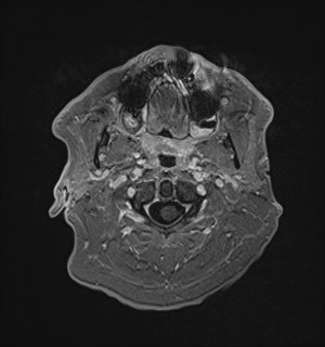 Neurofibromatosis type 2 (Radiopaedia 79097-92049 Axial T1 C+ 16).jpg