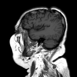 File:Neurofibromatosis type 2 (Radiopaedia 8713-9518 Sagittal T1 16).jpg