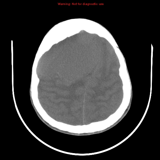 File:Neurofibromatosis type 2 (Radiopaedia 8953-9732 Axial non-contrast 26).jpg