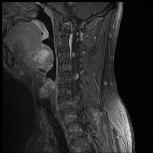 File:Neurofibromatosis type 2 (spinal manifestations) (Radiopaedia 53943-60070 G 8).png