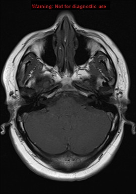 File:Neuroglial cyst (Radiopaedia 10713-11184 Axial T1 18).jpg