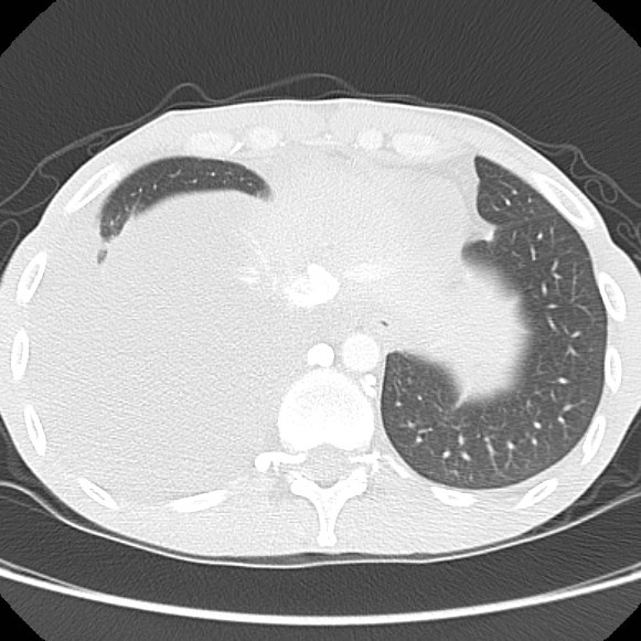 File:Non-Hodgkin lymphoma involving lung (Radiopaedia 29094-29470 Axial lung window 58).jpg