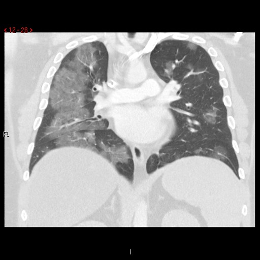 File:Non-specific interstitial pneumonitis (Radiopaedia 27044-27222 Coronal lung window 28).jpg