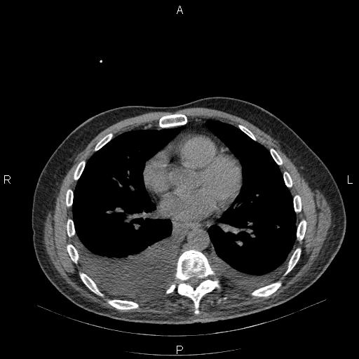 File:Non Hodgkin lymphoma in a patient with ankylosing spondylitis (Radiopaedia 84323-99624 Axial non-contrast 21).jpg