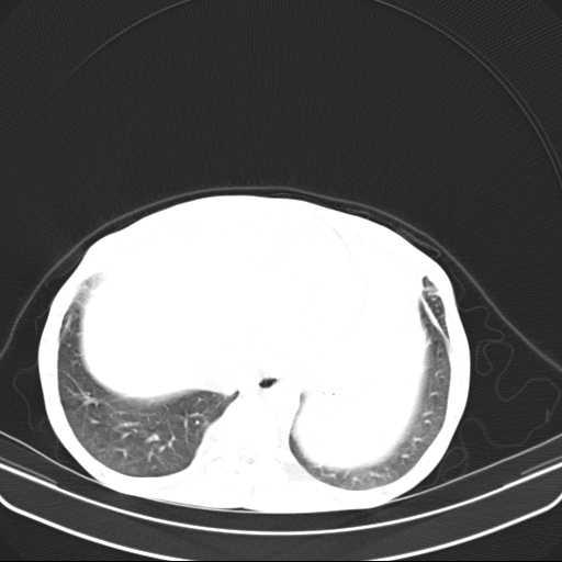 File:Non hodgkin lymphoma of the mediastinum (Radiopaedia 20814-20729 Axial lung window 46).jpg