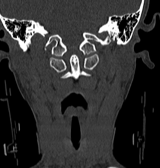 File:Normal CT cervical spine - 12-year-old (Radiopaedia 55352-61775 Coronal bone window 46).jpg