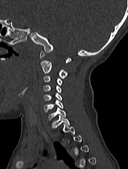 File:Normal CT cervical spine - pediatric (Radiopaedia 52549-58462 Sagittal bone window 147).jpg