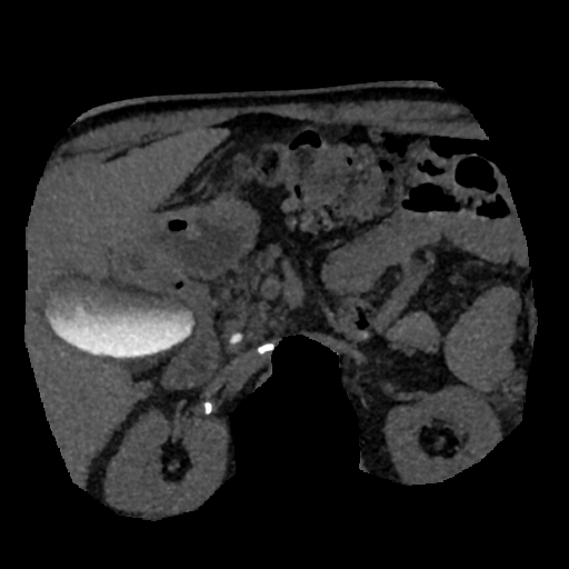 File:Normal CT intravenous cholangiogram (Radiopaedia 38199-40208 Axial IVC (MIP) 32).png